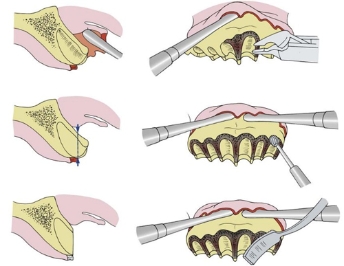 alveoloplasty in conjunction with extractions