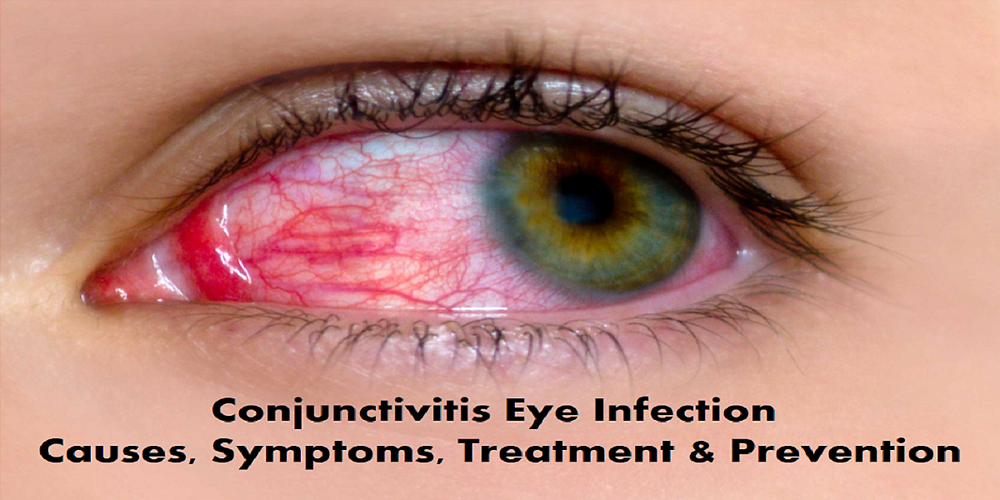 Conjunctivitis Eye Infection Causes Symptoms Treatment Prevention