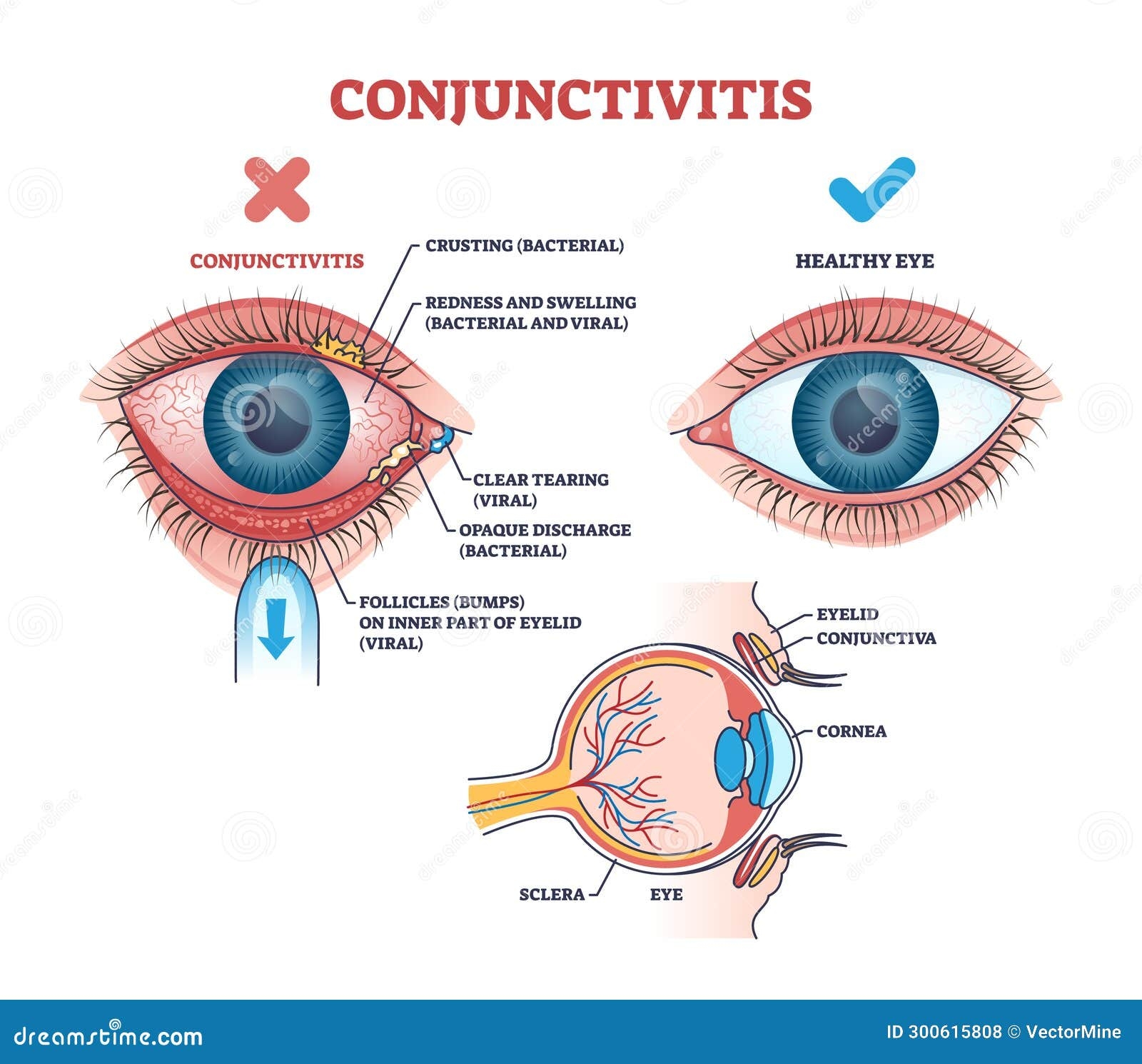 Conjunctivitis Or Pink Eye Causes Symptoms And Treatment Outline 
