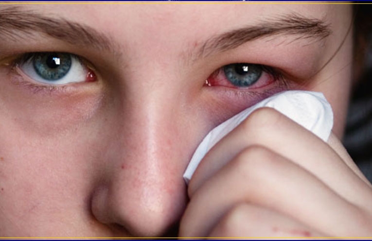 Conjunctivitis Symptoms Causes And Treatment Newsera in