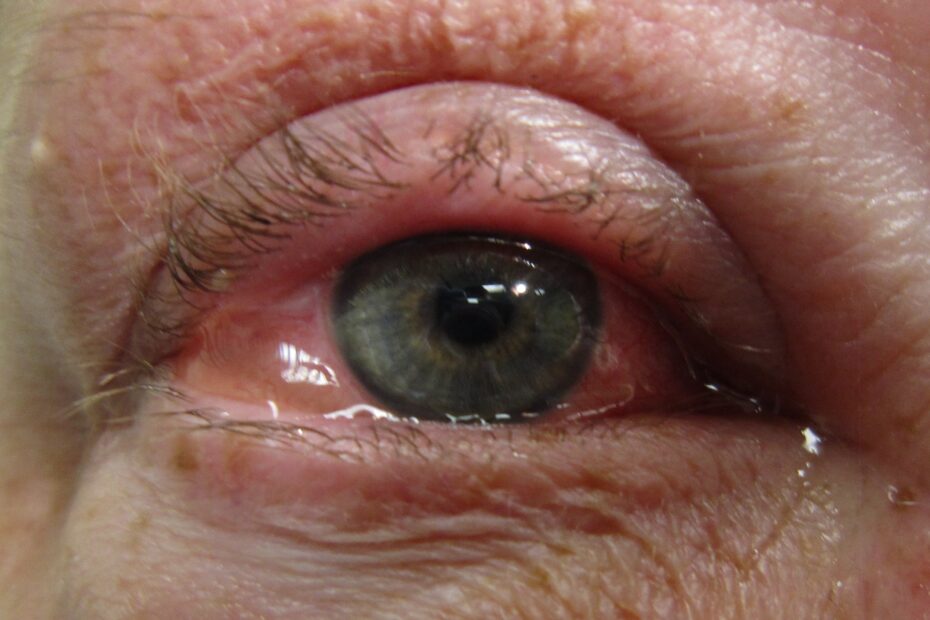 Conjunctivitis Taming The SRU