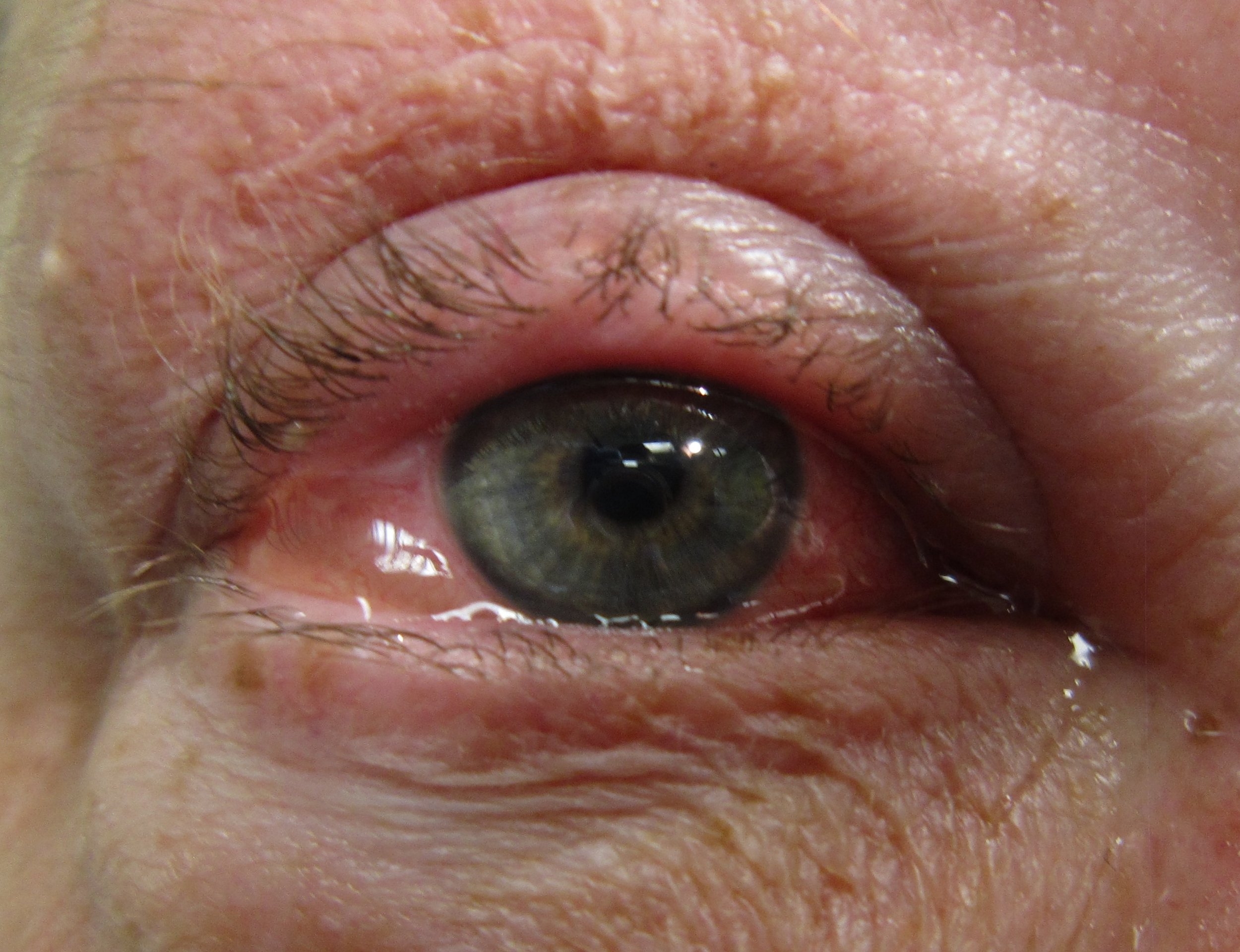 Conjunctivitis Taming The SRU