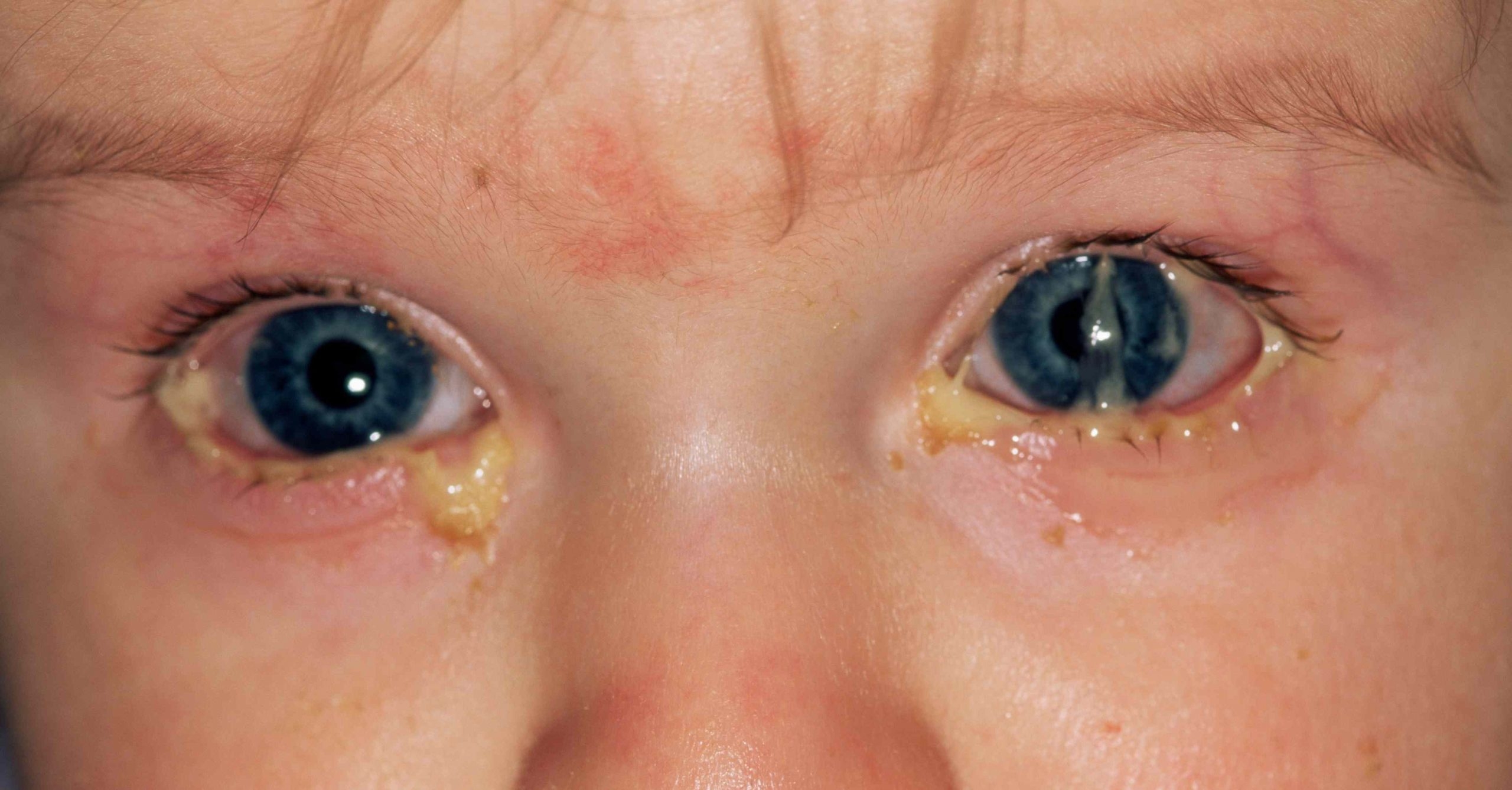 CPD Module Conjunctivitis Nursing In Practice