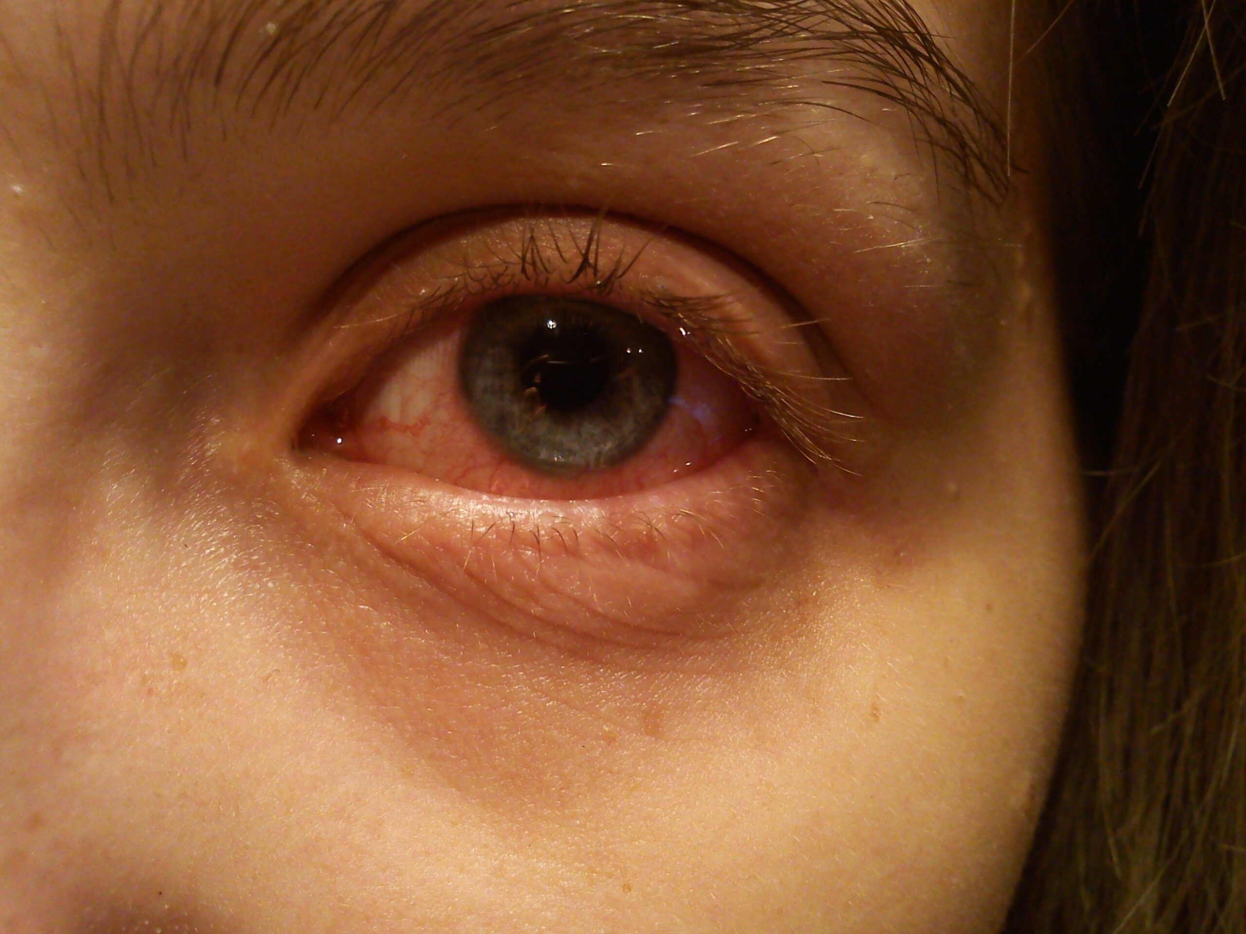 conjunctivitis.
