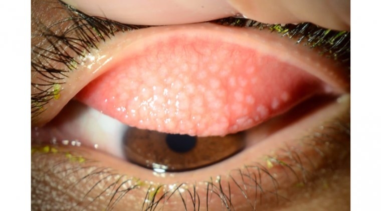 conjunctivitis.treatment