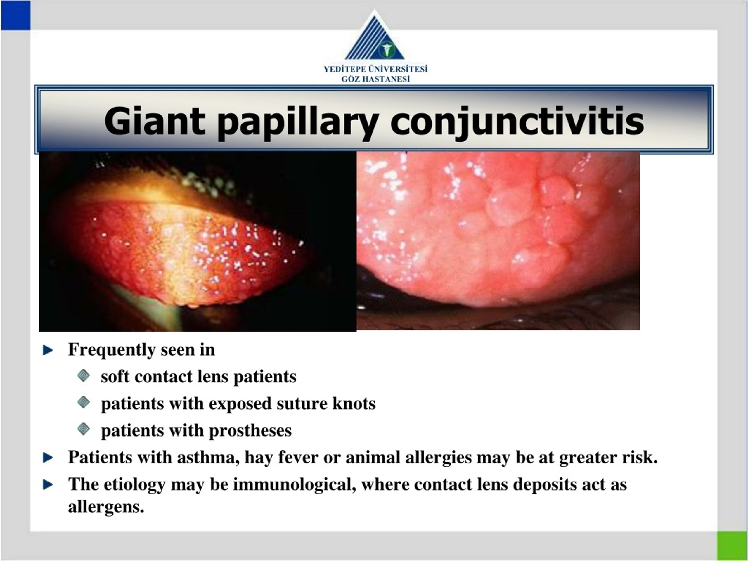 Giant Papillary Conjunctivitis Treatment