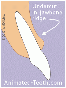 Guide To Alveoloplasty Why It s Important How It s Performed