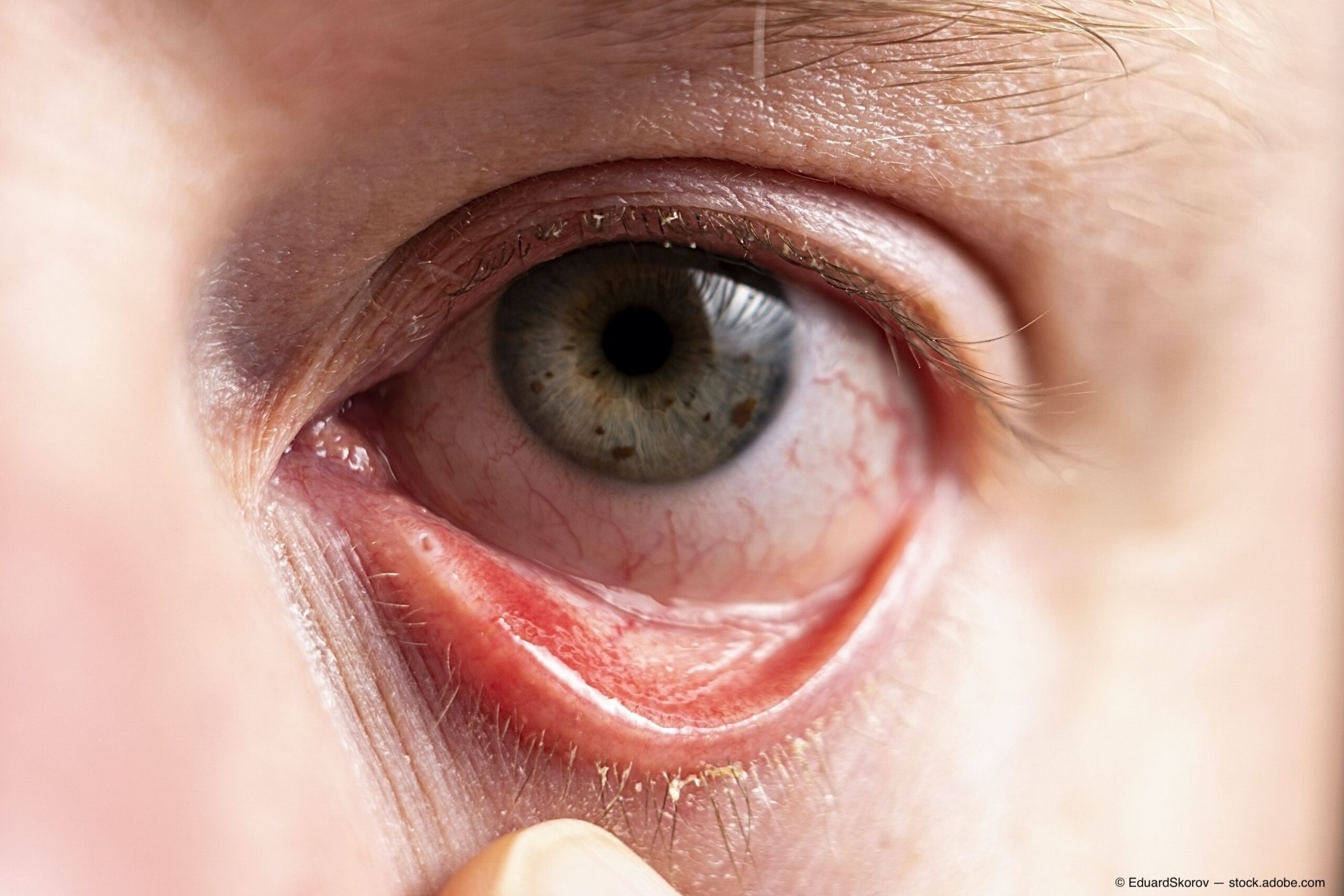 New Molecule For Allergic Conjunctivitis Makes Debut Ophthalmology Times