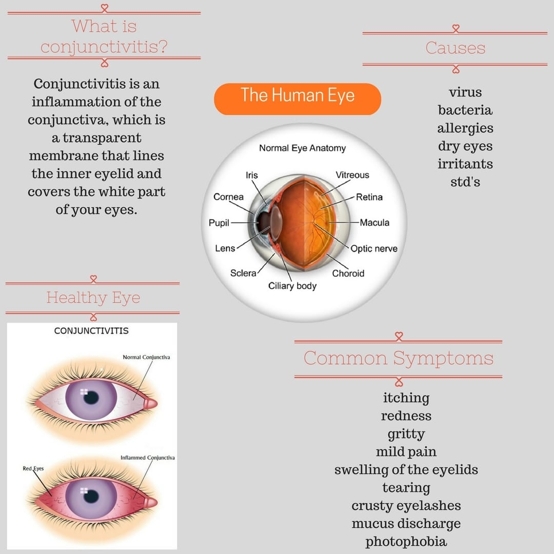 Pink Eye Conjunctivitis Treatment And Diagnosis 60 OFF