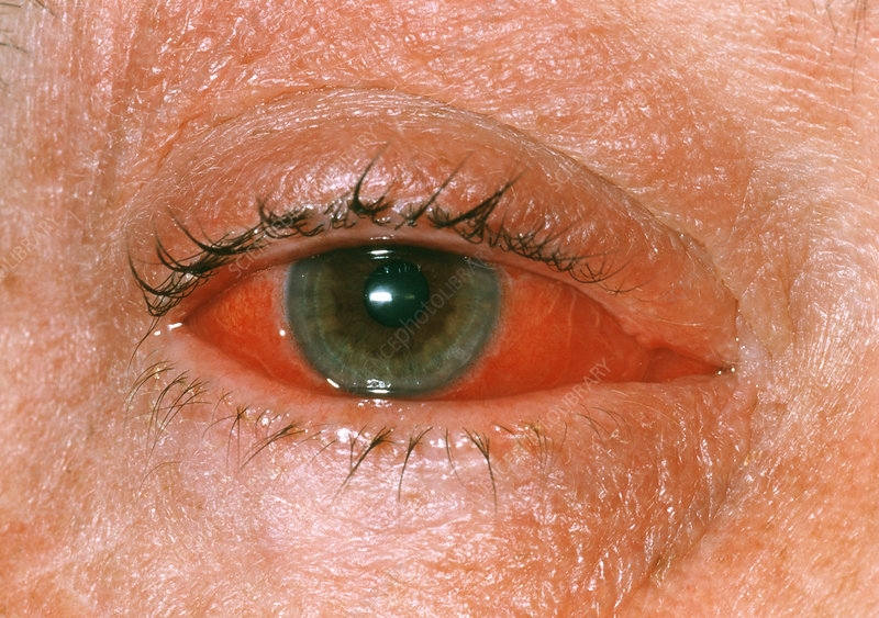 Viral Conjunctivitis Stock Image M155 0439 Science Photo Library