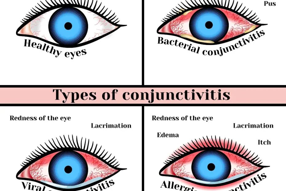 Viral Eye Infection Types Symptoms Treatment STD GOV Blog